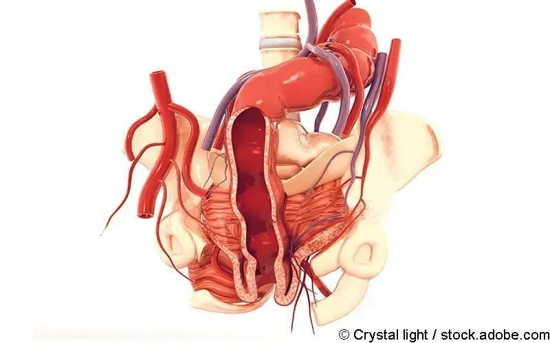 Analthrombose