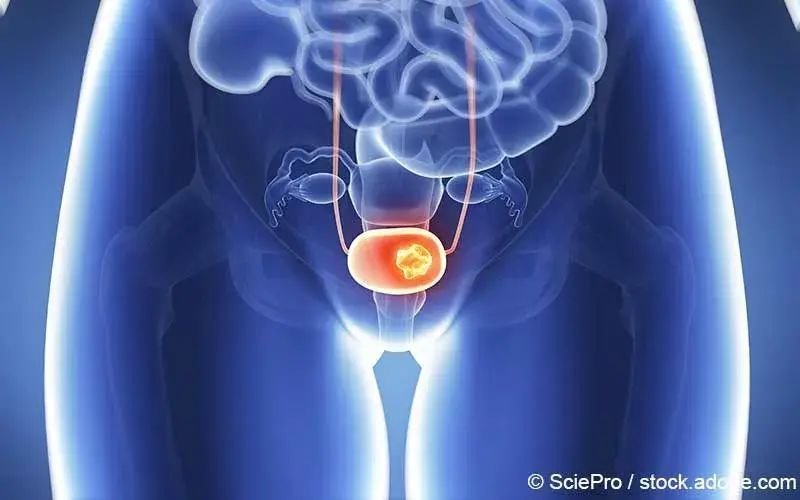 Blasenkrebs (Blasenkarzinom)