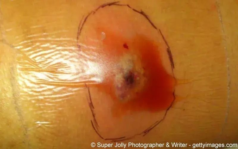 Dekubitus (Wundliegen)