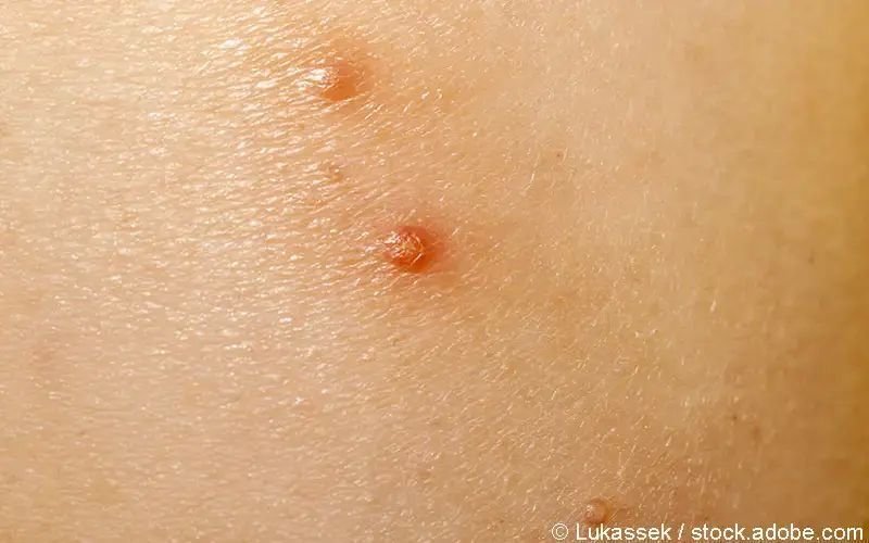 Dellwarzen mit essig behandeln