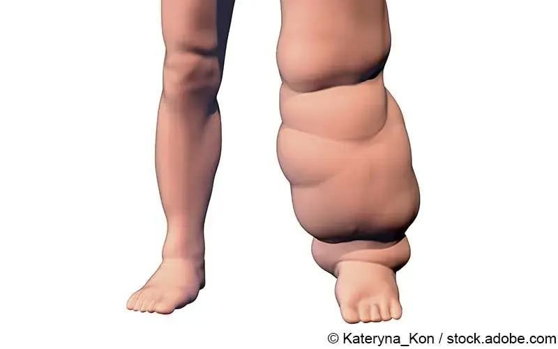 Elephantiasis Tropica