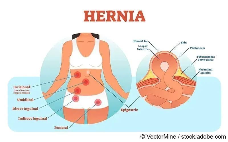 Epigastrische Hernie