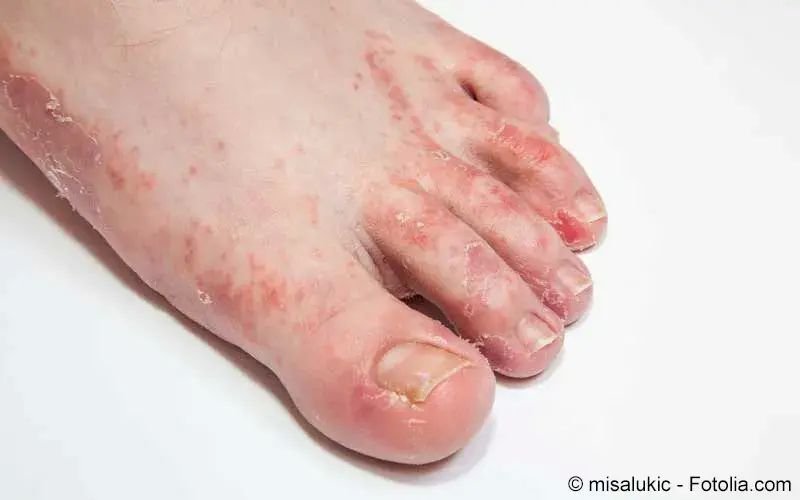 Fußpilz