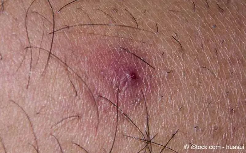 Karbunkel was ist das