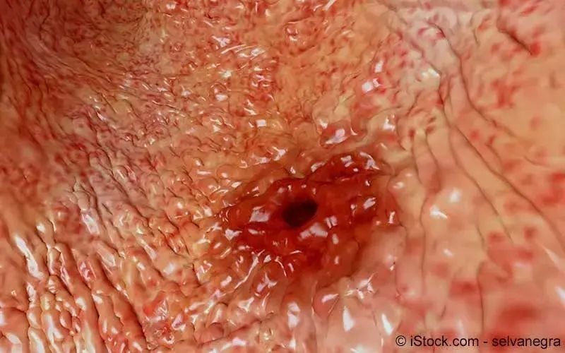 Magenschleimhautentzündung durch ultraschall erkennen