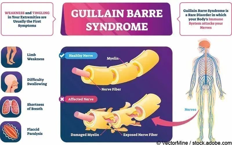 Guillain Barre Syndrome Ecg