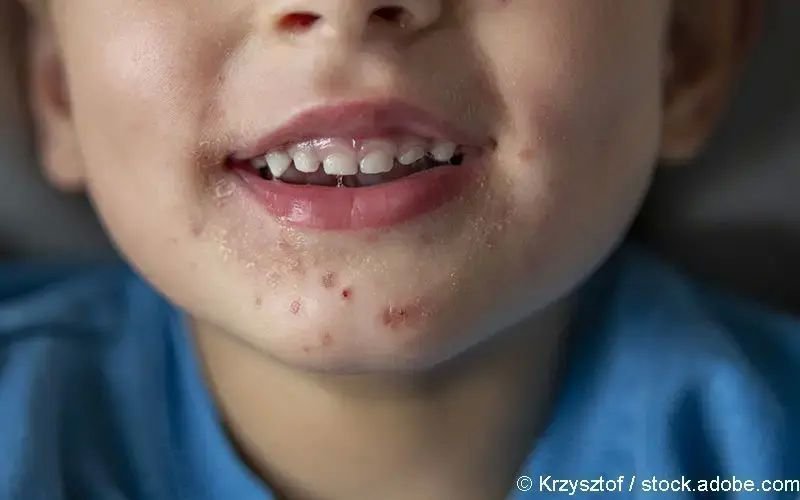 Hand-Mund-Fuß-Krankheit (Hfm-Krankheit)