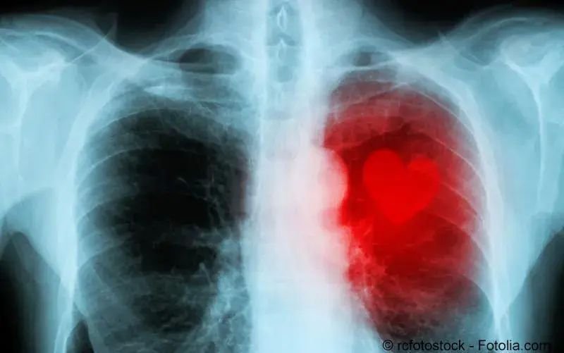 Herzmuskelentzündung wie lange ruhe