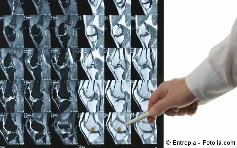 Knochenkrebs (Osteosarkom)