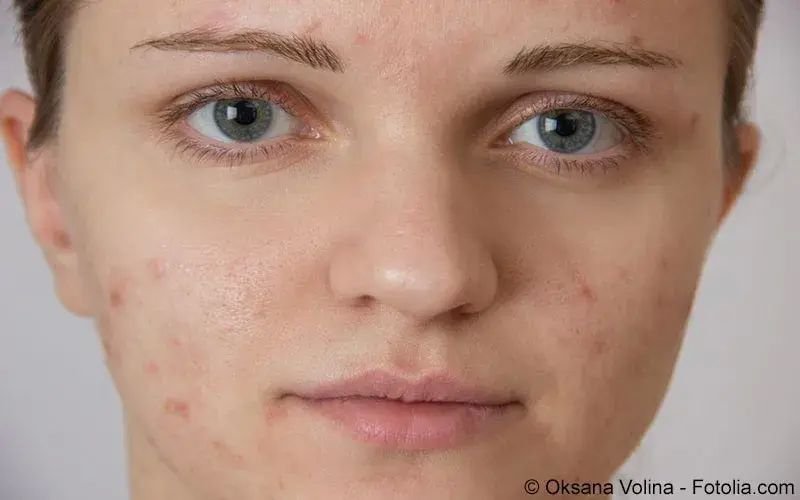 Lupus erythematodes hund therapie