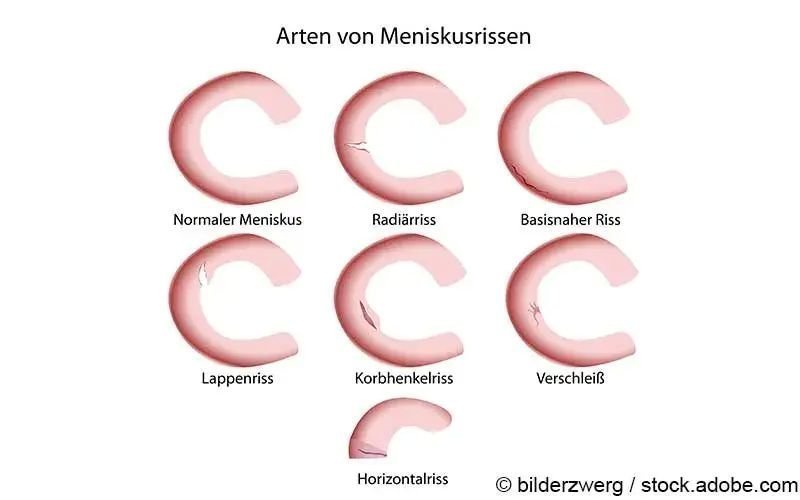 Muss meniskusriss sofort operiert werden