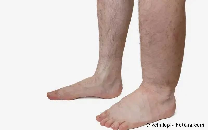 Ödem – Wasser İm Gewebe