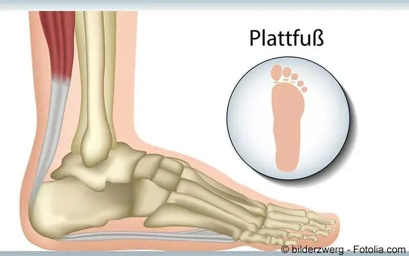 Plattfuß
