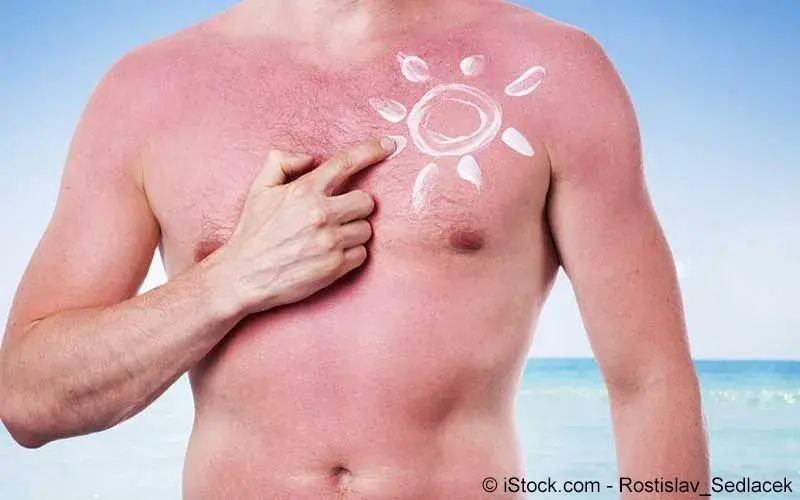Sonnenbrand