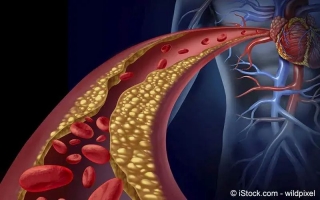 Arteriosklerose (Arterienverkalkung)