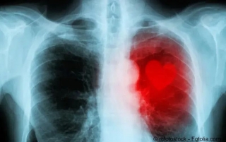 Herzmuskelentzündung (Myokarditis)