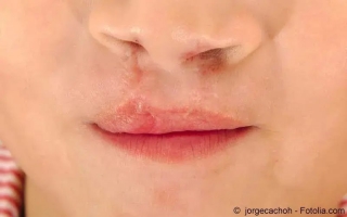 Lippen-Kiefer-Gaumenspalte