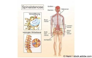 Spinalkanalstenose