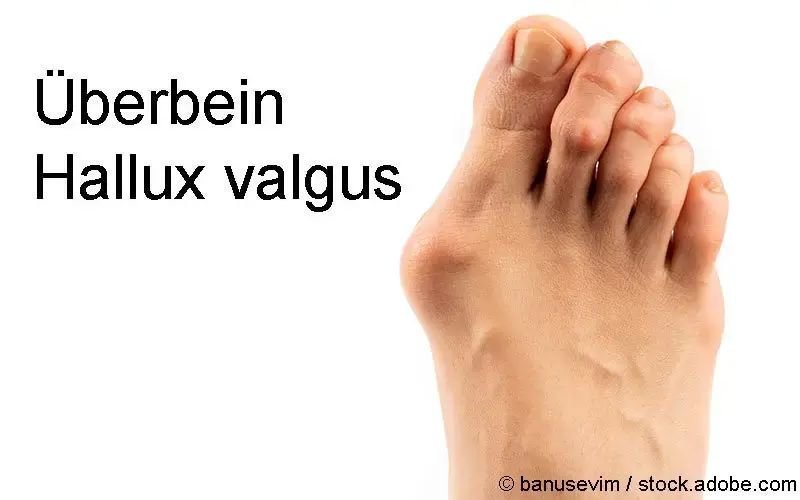 Überbeine